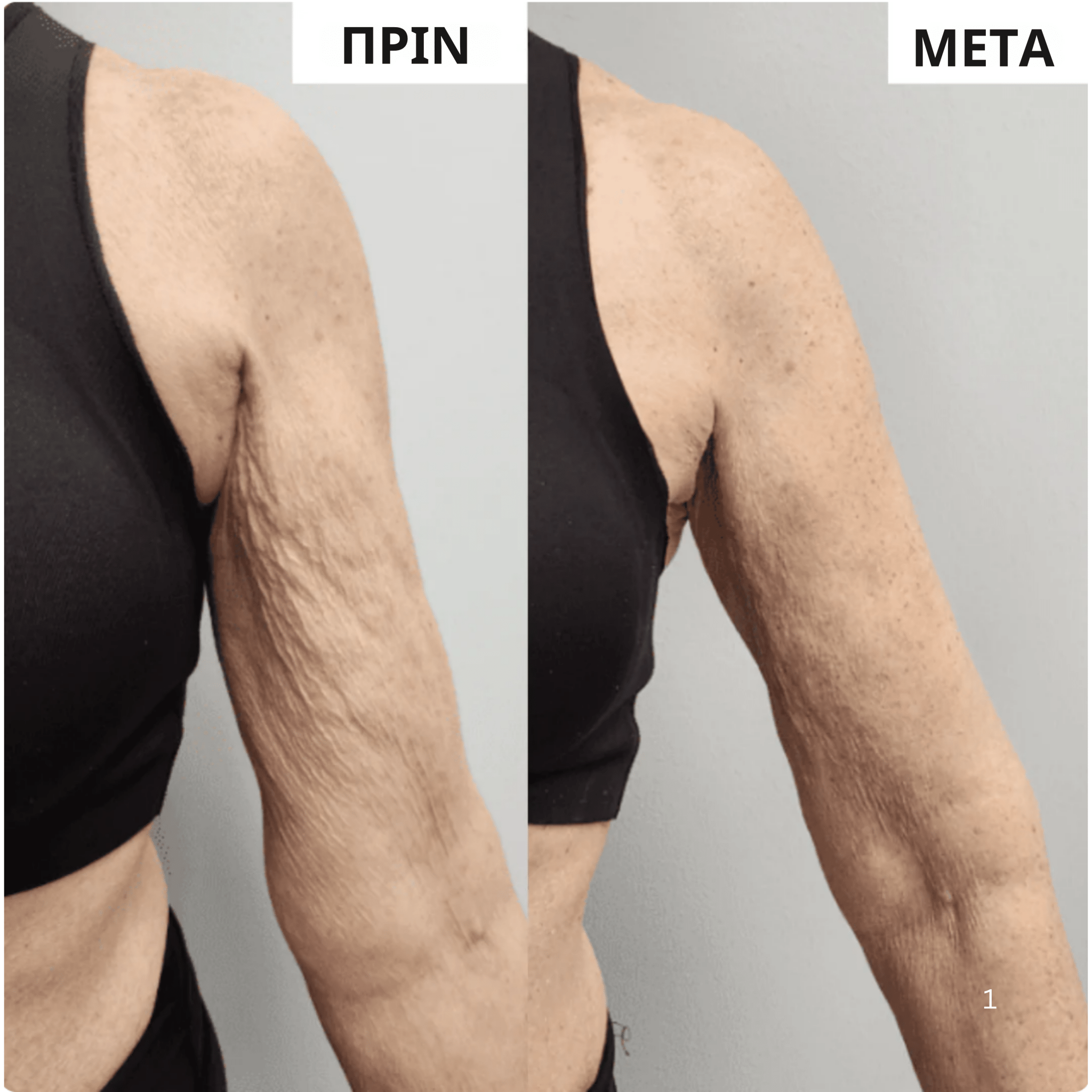 Kallisti - Θερμοτονικό Μανίκι Χεριών - Kallisti